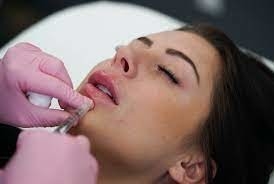 GMP Juvederm Ultra 3 HA Dermal Filler для губ Juvederm Vollure
